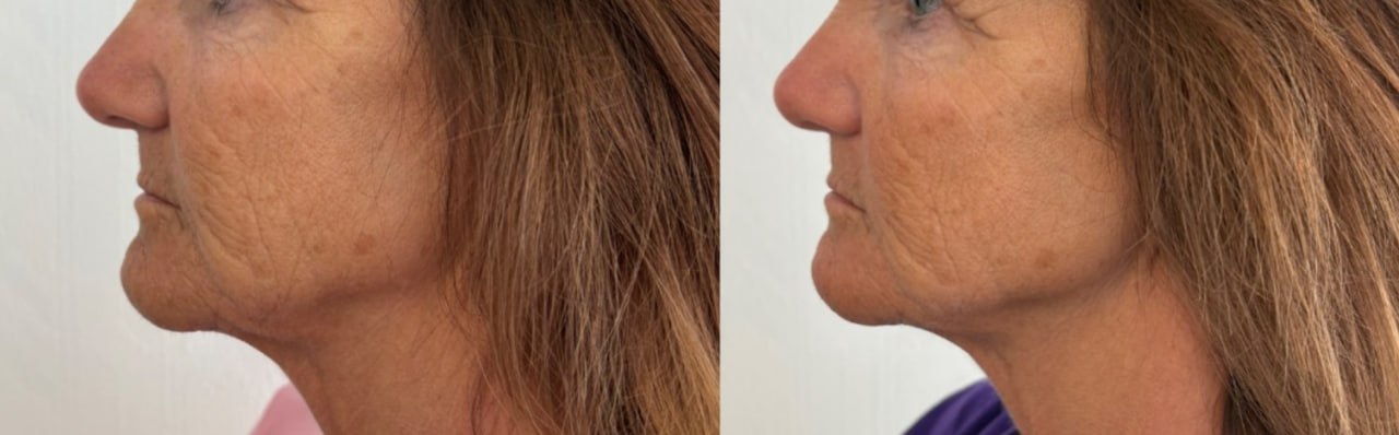 Collagen building skin resurfacing before and after, Skin Solution MedSpa Boardman Ohio