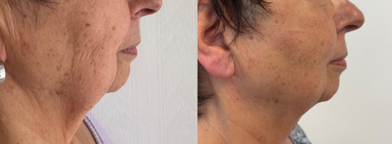 Crepey neck and jawline before and after treatment, Skin Solution MedSpa Boardman Ohio