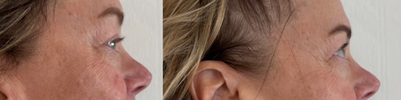 Crow's feet before and after treatment, Skin Solution MedSpa Boardman Ohio