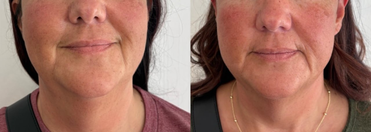 Neck and jawline definition before and after HIFU treatment, Skin Solution MedSpa Boardman Ohio