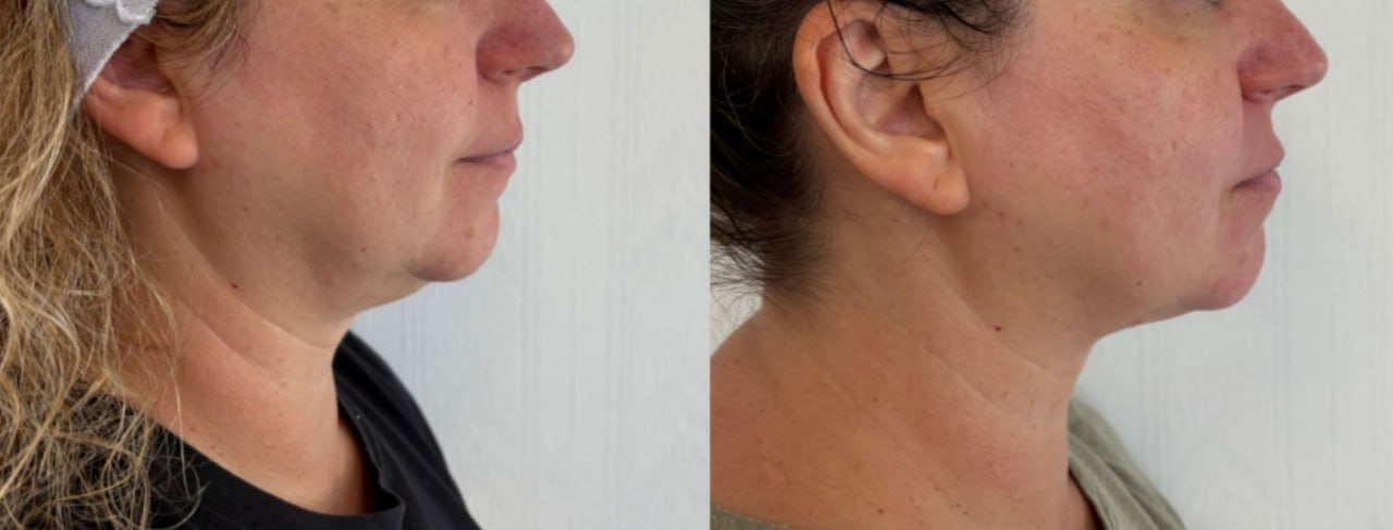 Double chin before and after fat reduction treatment, Skin Solution MedSpa Boardman Ohio