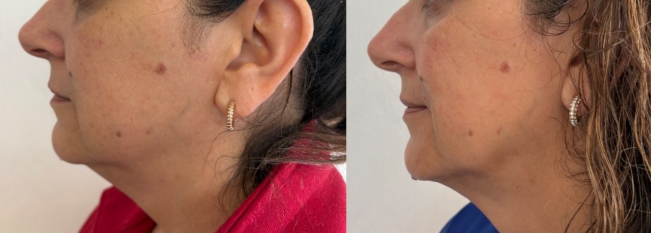 Non-surgical facelift before and after 3/4 view, Skin Solution MedSpa Boardman Ohio