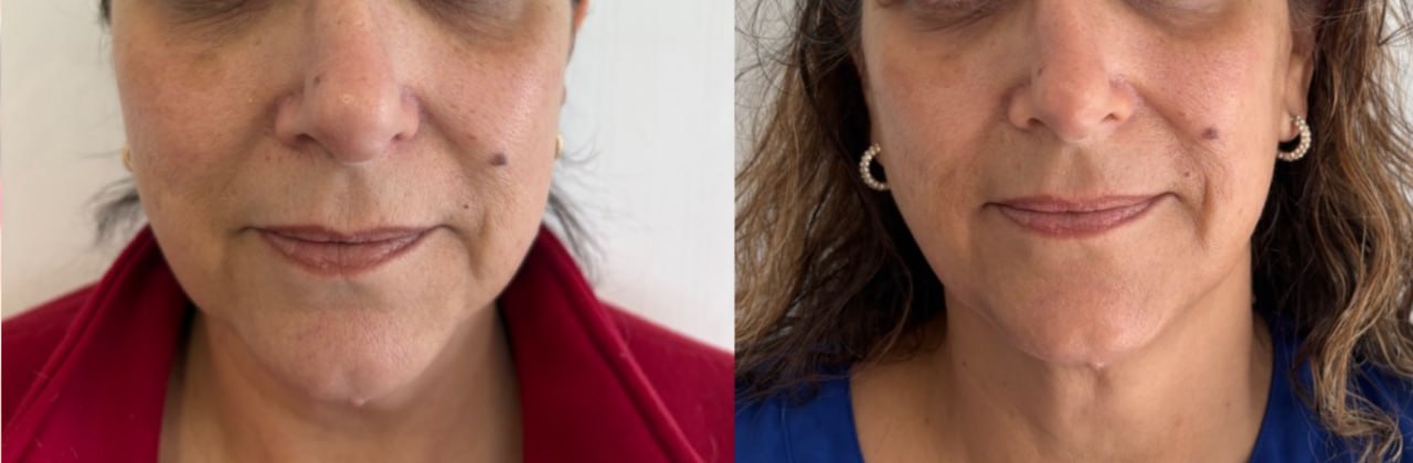 Non-surgical facelift before and after front view, Skin Solution MedSpa Boardman Ohio