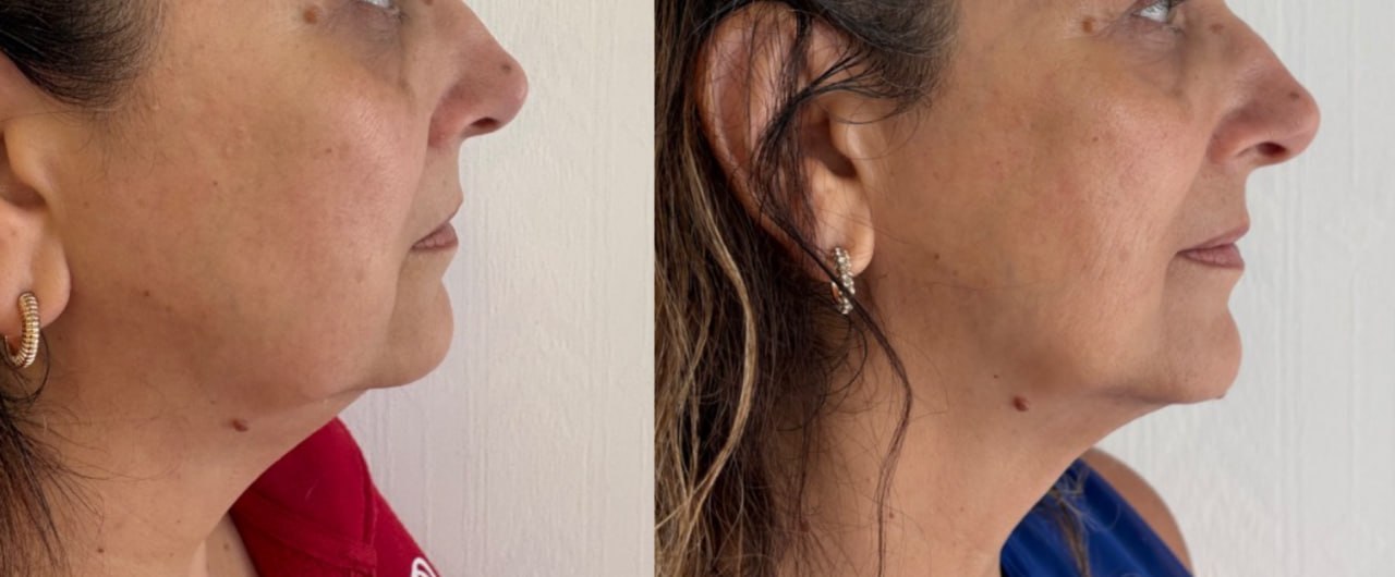 Non-surgical facelift before and after profile view, Skin Solution MedSpa Boardman Ohio