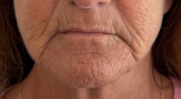 Lip lines after one collagen building treatment