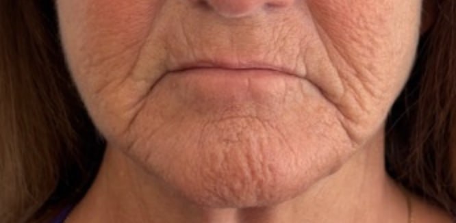 Lip lines before collagen building treatment