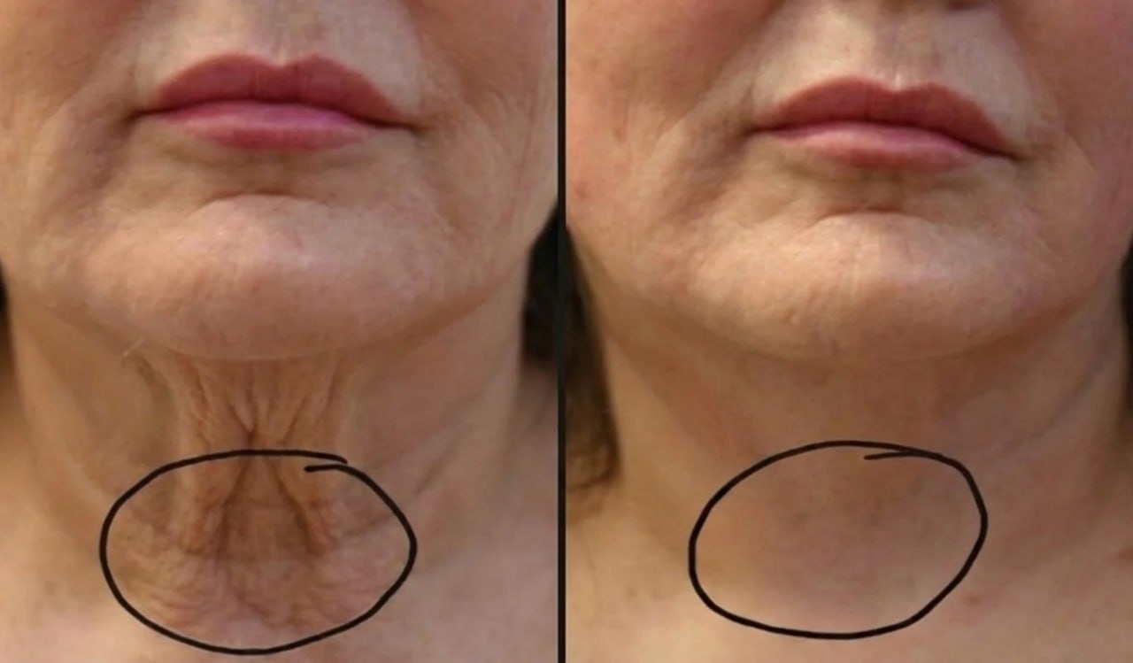 Neck crepey skin before and after treatment, Skin Solution MedSpa Boardman Ohio