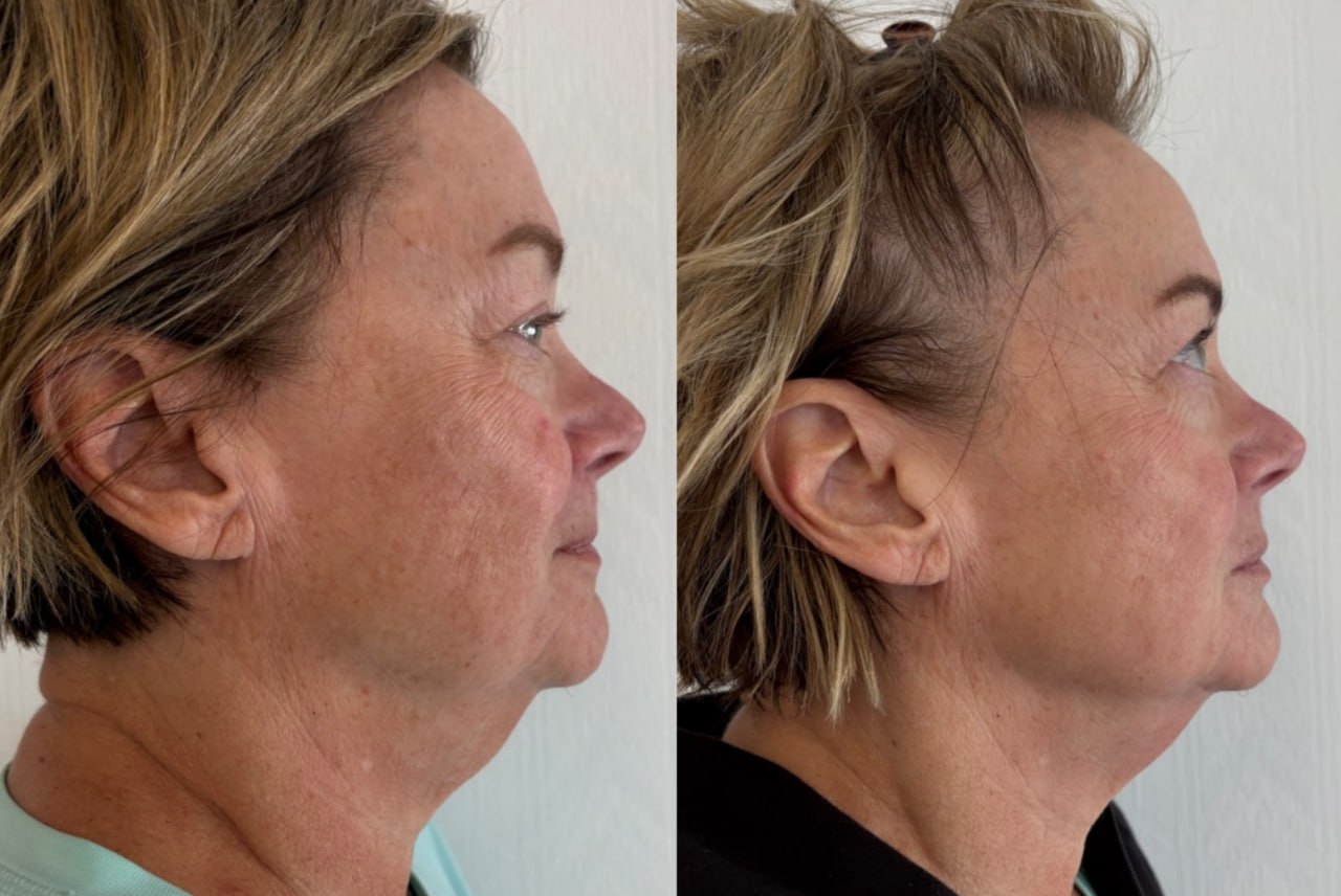 Full face profile before and after non-surgical facelift, Skin Solution MedSpa Boardman Ohio