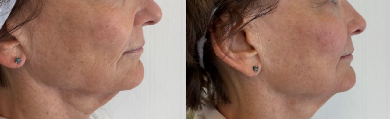 Jowl lift before and after one treatment same day, Skin Solution MedSpa Boardman Ohio