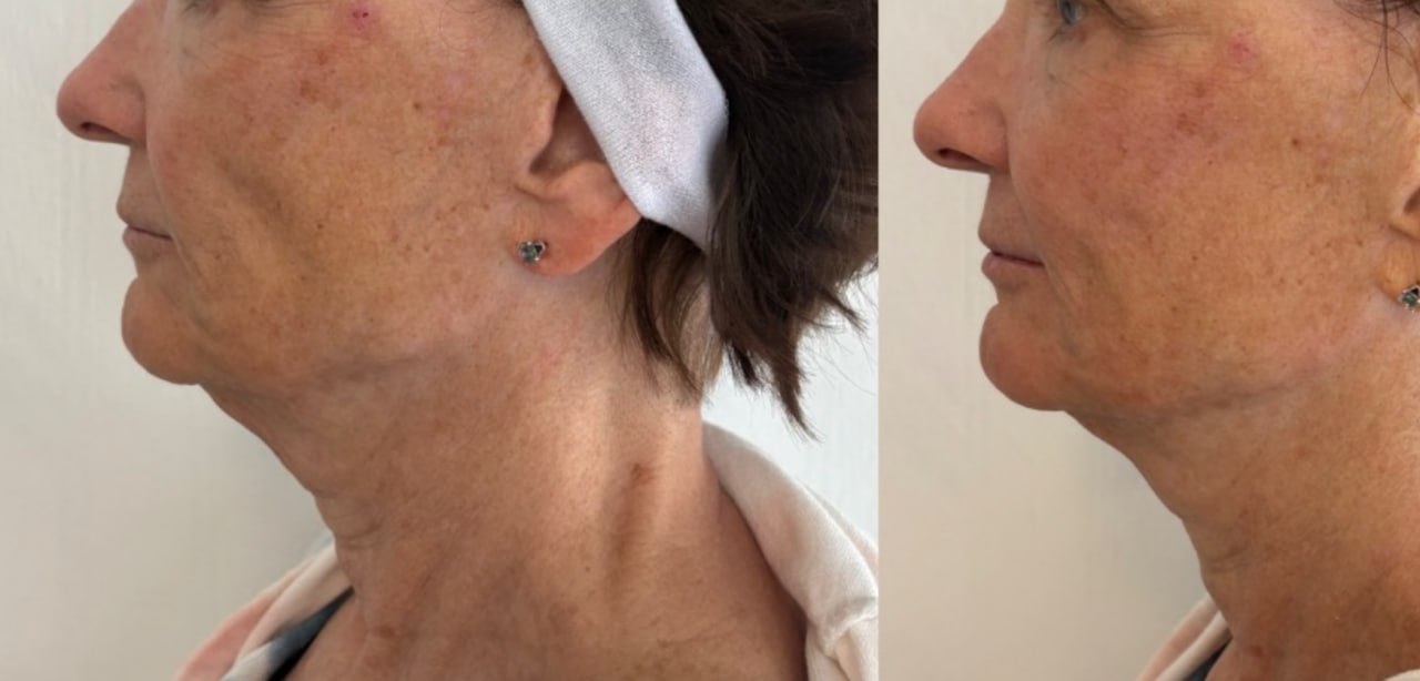 Non-surgical facelift neck and cheek lift before and after one treatment, Skin Solution MedSpa Boardman Ohio