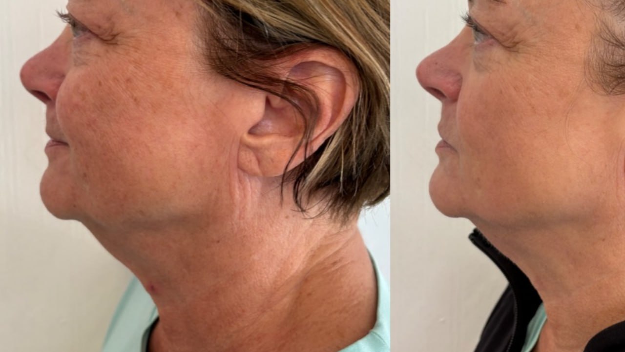 Jowl lift and turkey neck before and after, Skin Solution MedSpa Boardman Ohio
