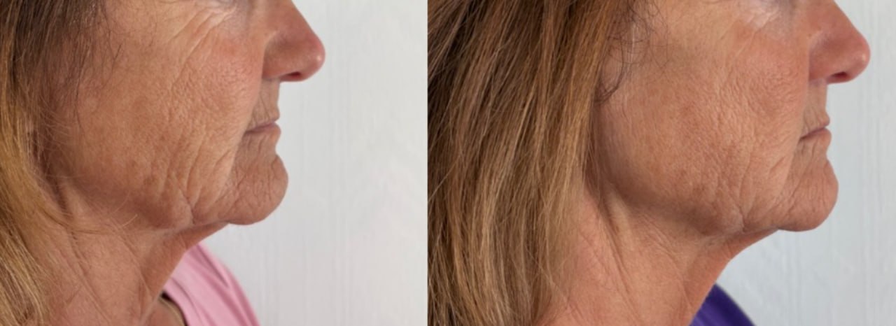 Turkey neck and deep cheek wrinkles before and after, Skin Solution MedSpa Boardman Ohio