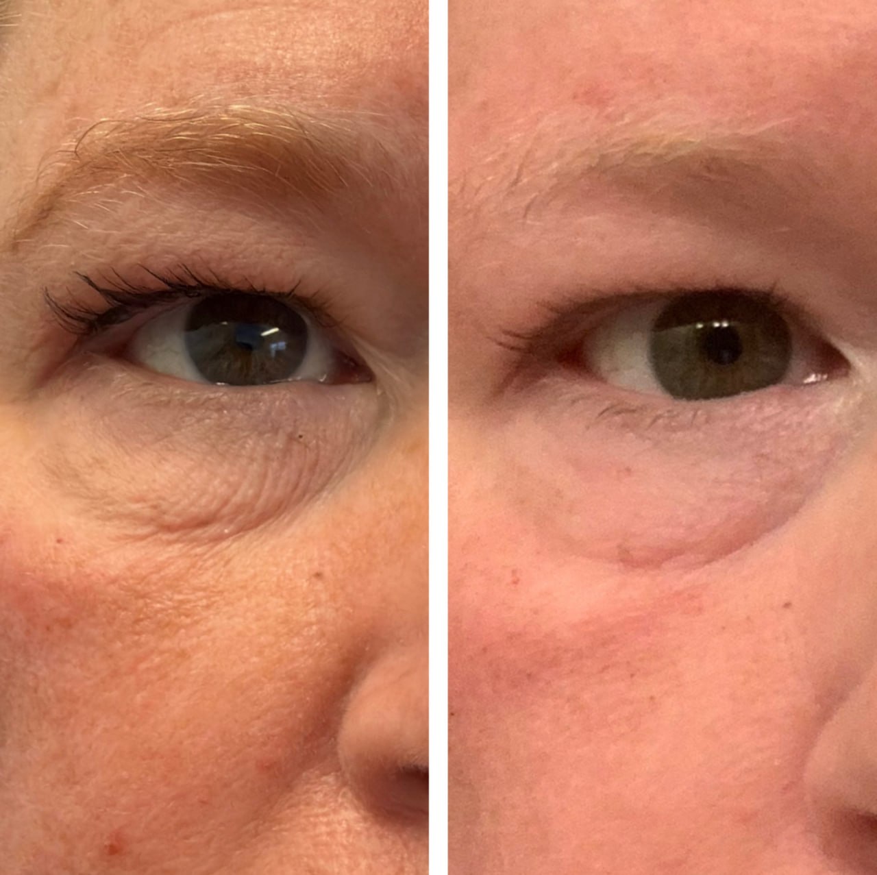 Under eye crepey skin before and after one treatment, Skin Solution MedSpa Boardman Ohio