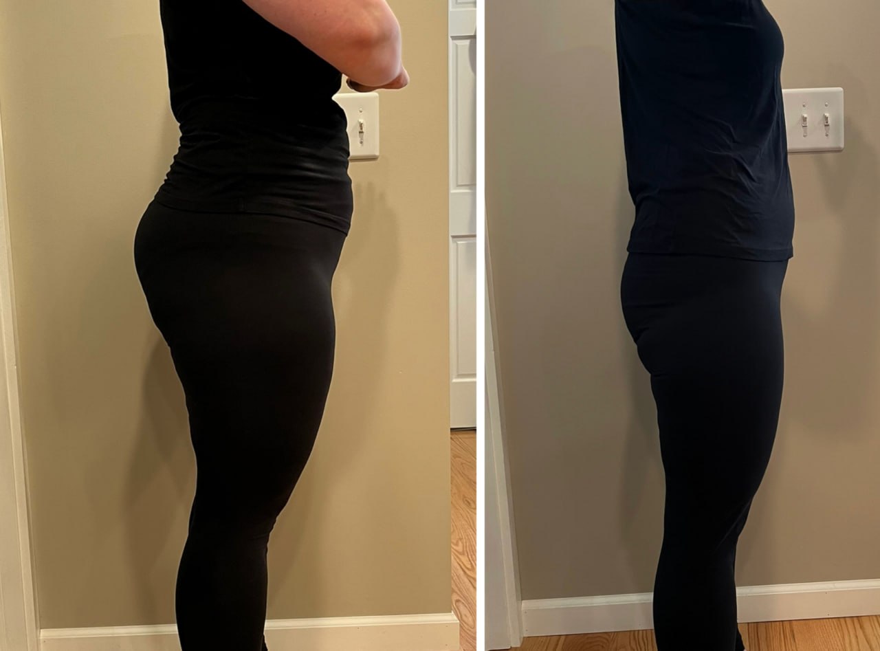 Weight loss before and after side view at Skin Solution MedSpa
