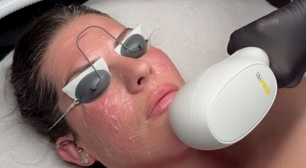 IPL photofacial treatment for sun damage and dark spots at Skin Solution MedSpa Boardman Ohio